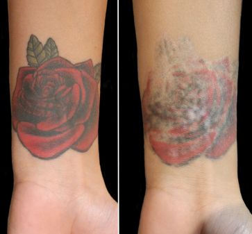 Three Things You Need to Know Before Tattoo Removal