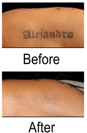 Benefits of Using Tattoo Removal Machines