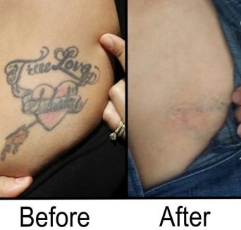 Are Tattoo Removal Creams Really Effective?