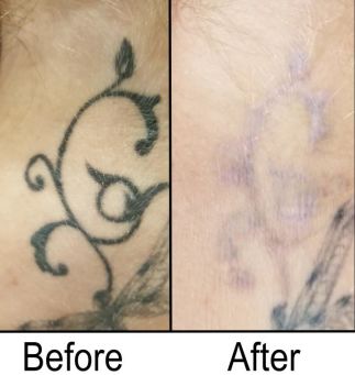 How to Choose the Best Tattoo Removal Training School